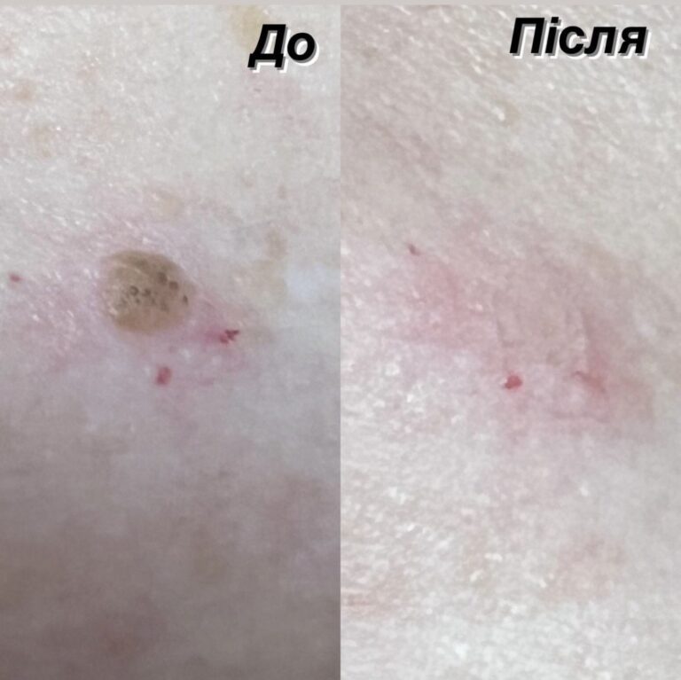 Видалення родимки — результат до та після процедури