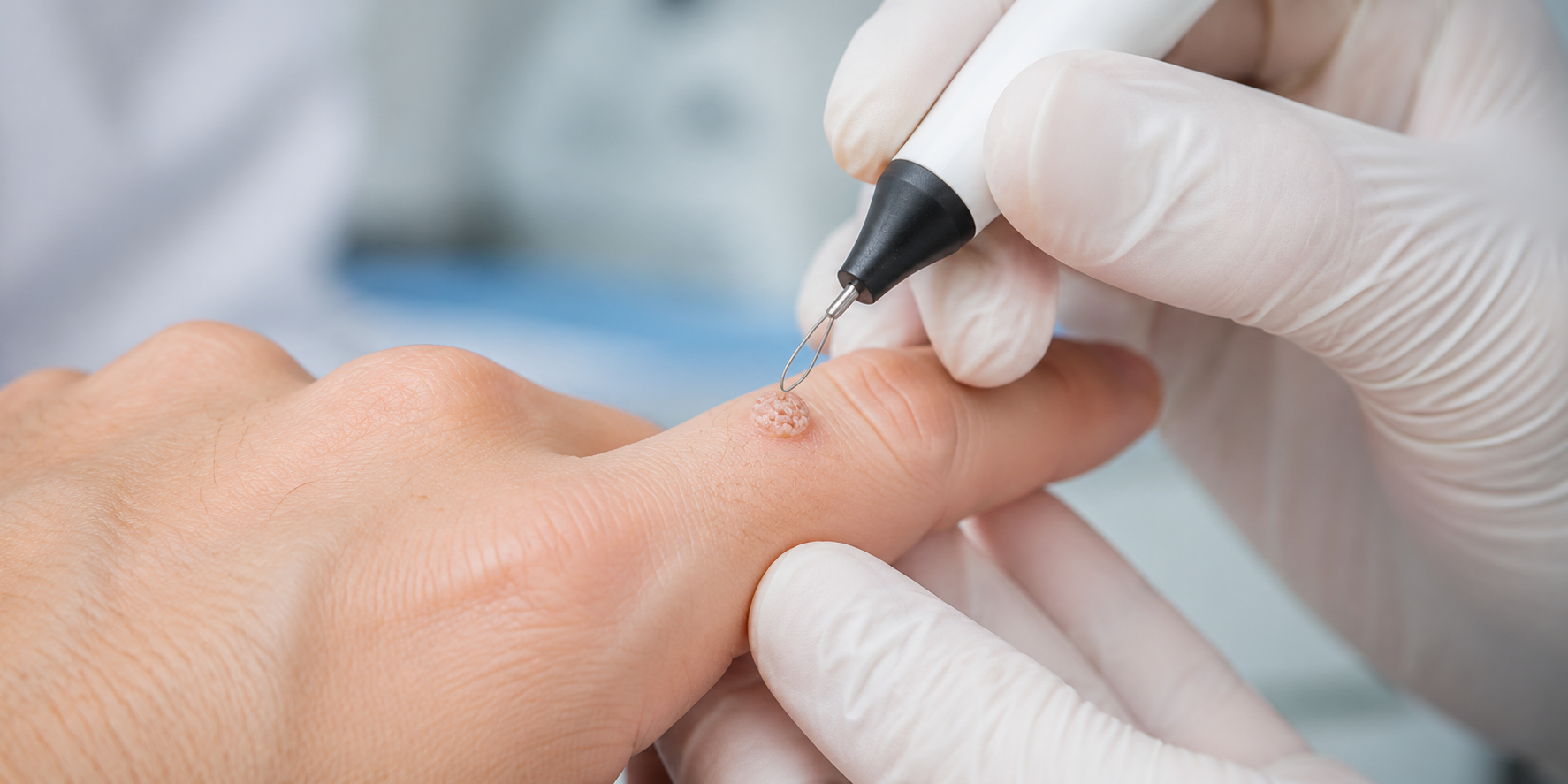 Видалення бородавок радіохвильовим методом у SkinCare Clinic в Києві