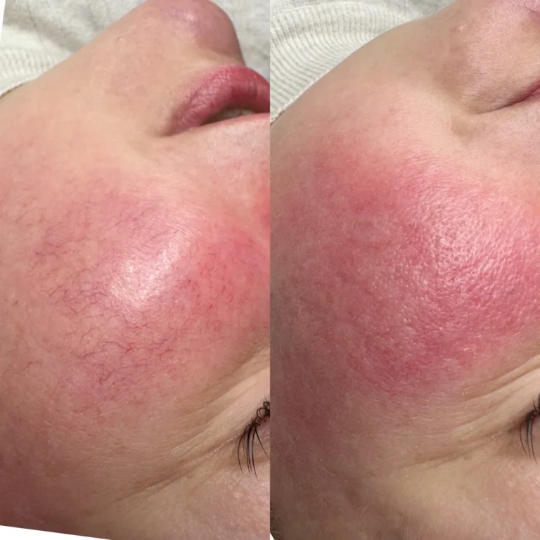 IPL-фотолікування розацеа до та після у SkinCare Clinic в Києві