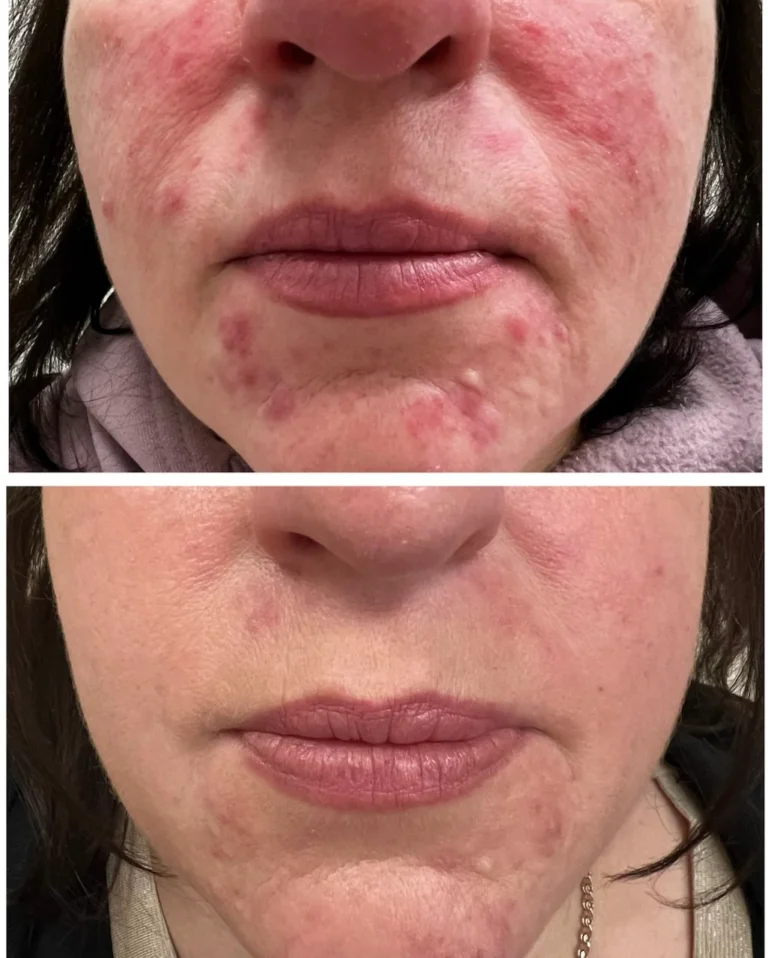 Лікування розацеа до та після у SkinCare Clinic в Києві