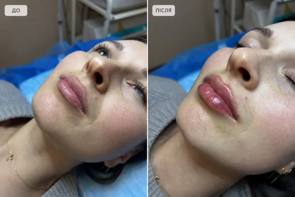 Губи до та після збільшення філером у SkinCare Clinic у Києві